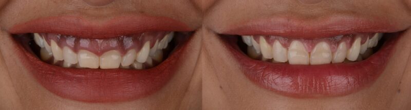 Un paciente con sonrisa gingival antes y después de la intervención