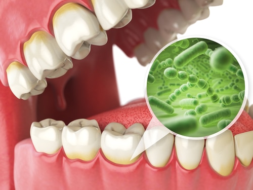 牙科医学在发展，但它要对付的细菌也在发展