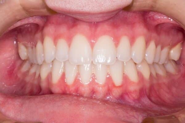 Gum Bleaching Specialist Dark Gum Treatments