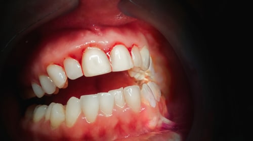 牙龈疾病治疗是当务之急 比佛利山庄法诺什医生