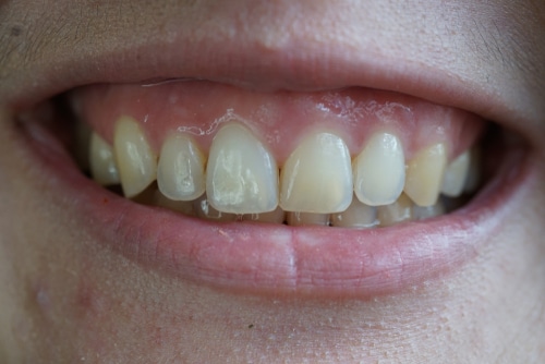 High,Smile,Line,(gummy,Smile) - Gummy Smile Procedure Enhances Lips Without Fillers Dr. Farnoosh