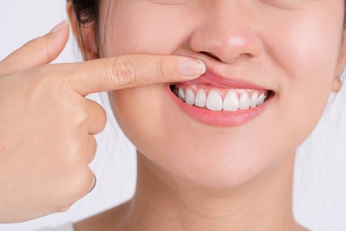 Tratamiento de la sonrisa gingival por nuestro dentista cosmético en Los Ángeles