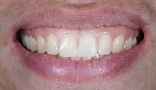 Closeup,Gummy,Smile,With,White,Tooth - Los Angeles Smile Makeover for Gummy Smile Periodontist Los Angeles