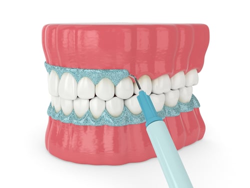 比佛利山牙医发现专有牙龈漂白技术优于激光方法