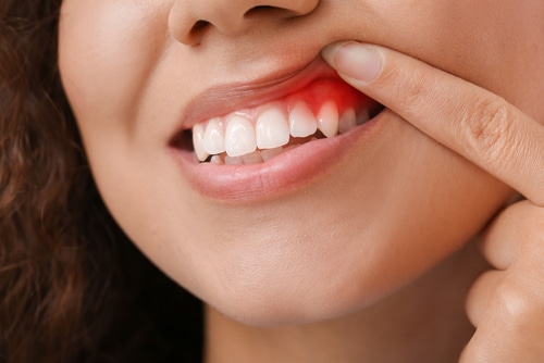 Landmark Dental School Study to Use Genetic Testing to Predict Gum Disease