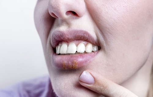 牙周病专家讨论口腔 HPV 感染研究