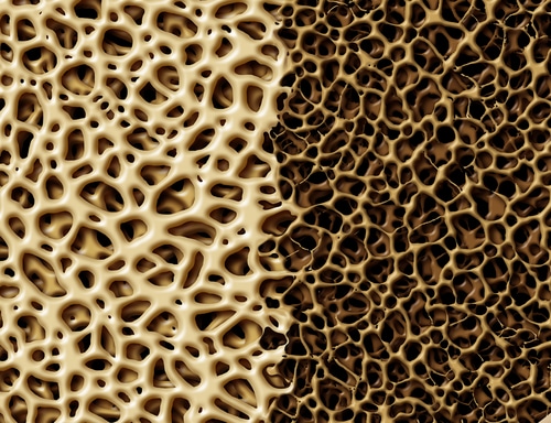 Un periodoncista habla de los efectos de la terapia antirresortiva para la osteoporosis