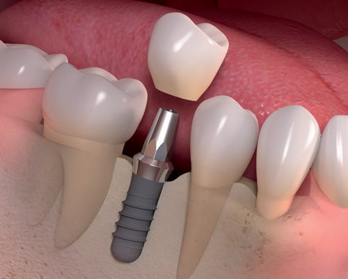 dental implant specialist in Los Angeles