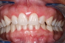 Before & After Gum Bleaching Treatment - Dr. Farnoosh