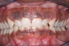牙龈漂白治疗前后对比