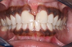 牙龈脱色前后对比