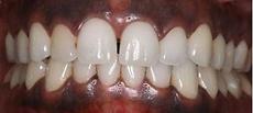 Gum Bleaching Dentist in Los Angeles