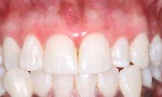 Gum Bleaching Treatment Los Angeles - Before & After