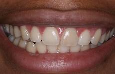 牙龈漂白、牙龈微笑矫正 - 前后对比