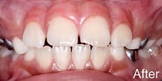 Gum Bleaching Before & After in Los Angeles CA