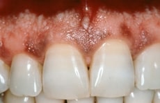 Gum Depigmentation in Los Angeles - Dr. Alex Farnoosh - The Total Smile