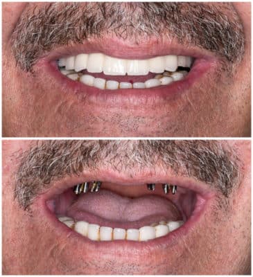 Reconstrucción,completa,del,maxilar,superior,con,implantes - Procedimiento de implante dental - Implantes dentales en Beverly Hills CA