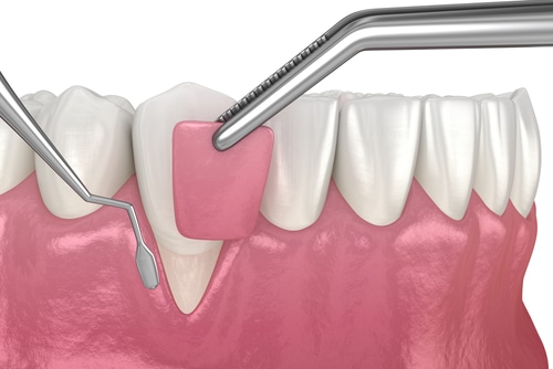 牙龈,衰退:,软组织,移植,手术...,3d,插图,的,牙科 - 牙龈移植和根覆盖牙周病学家洛杉矶黑暗牙龈