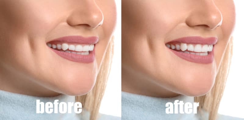Young,Woman,Before,And,After,Procedure,Of,Gingival,Plasty,On - Lip Lowering for Gummy Smile - Gummy Smile Treatment in Los Angeles - Dr. Alex Farnoosh