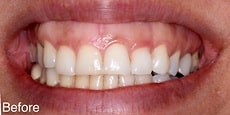 牙龈微笑治疗前 - Dr.亚历克斯-法诺什 - 洛杉矶牙龈笑治疗