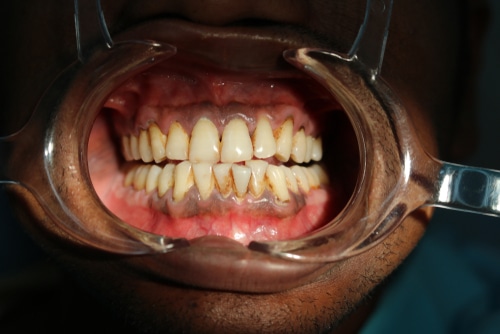 Gum Discoloration in Los Angeles Dr. Alex Farnoosh