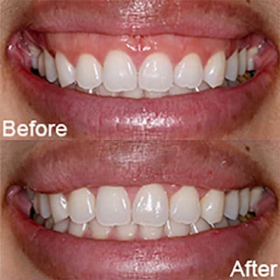 Solutions for Excessive Gingival Display