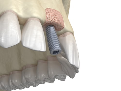 Bone Grafting Treatment Facts Beverly Hills Dentist Free Consultations