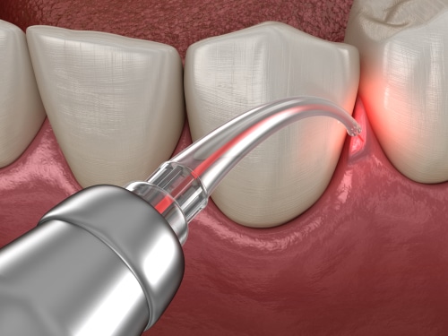 Gum Disease Treatment Periodontitis LA Dentist Free Consultation