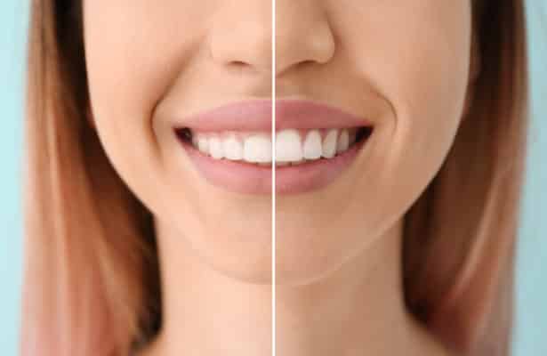 Reshaping Gums for a Better Smile LA Dentist Free Consultation