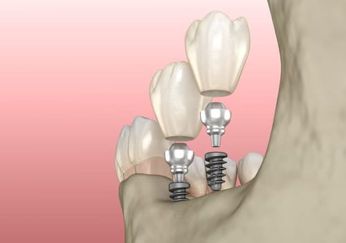 Dental Surgery Dental Implants Beverly Hills Dentist Free Consultation