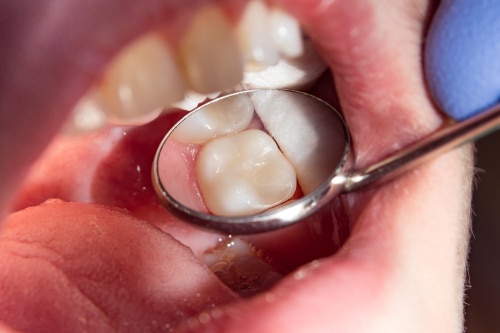 Poor Oral Hygiene in Los Angeles Periodontist Dr. Alex Farnoosh