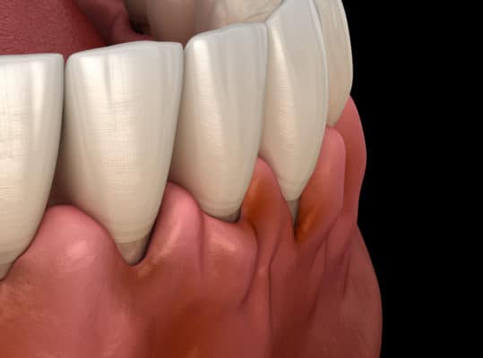 gingival fibromatosis beverly hills dentist free consultaiton
