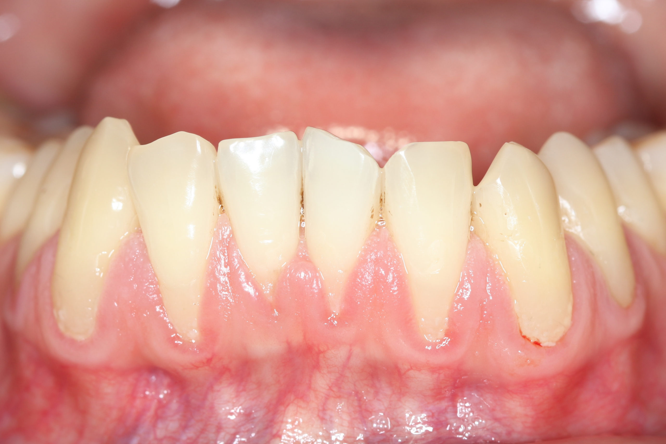 Gum Recession Treatment and Prevention Beverly Hills Periodontist