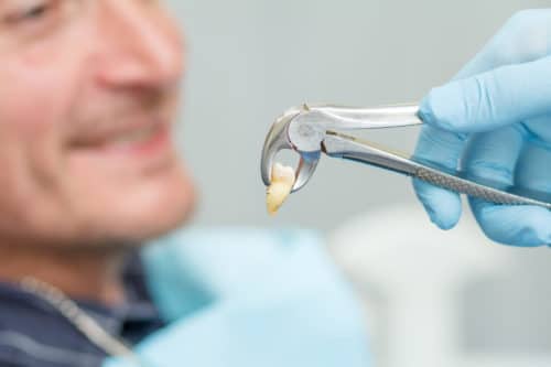 Tooth Extraction What You Need to Know Beverly Hills Extraction Dentist