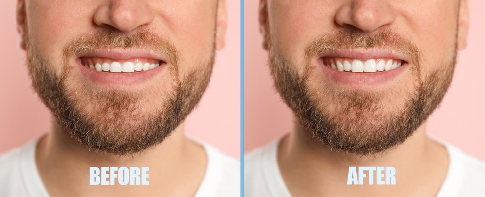 Young,Man,Before,And,After,Gingivoplasty,Procedure,On,Beige,Background,