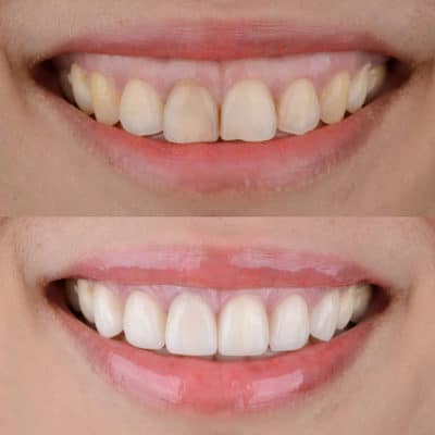 Tratamiento de reposicionamiento labial para la corrección de la sonrisa gingival