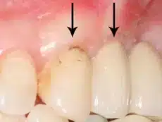 Gum Grafting Before & After Dr. Alex Farnoosh The Total Smile