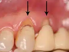 Gum Grafting Before & After Dr. Alex Farnoosh The Total Smile