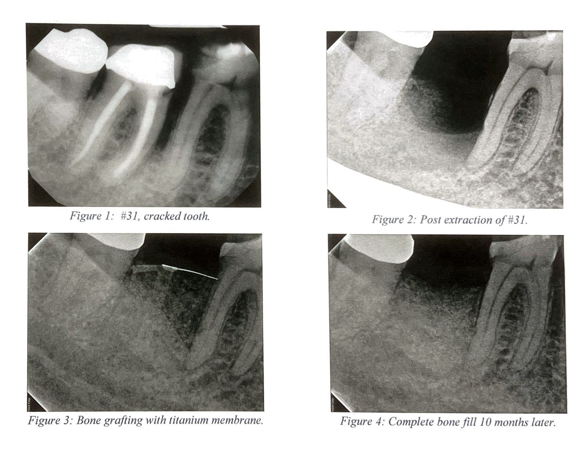 Bone Grafting for Dental Implants in Beverly Hills, CA | Call Today